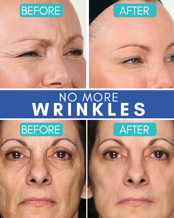 LineOff™ Anti-Wrinkle Patches